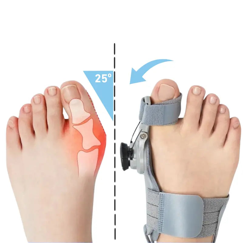 Illustration som visar vinkeljustering på tåskena för hallux valgus
